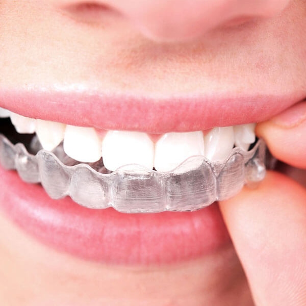 Close-up photo of patient putting their Invisalign clear aligner tray onto their upper teeth